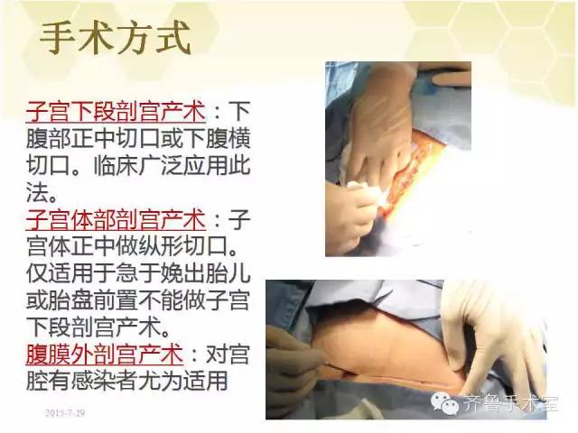【ppt】剖宫产术的配合及护理