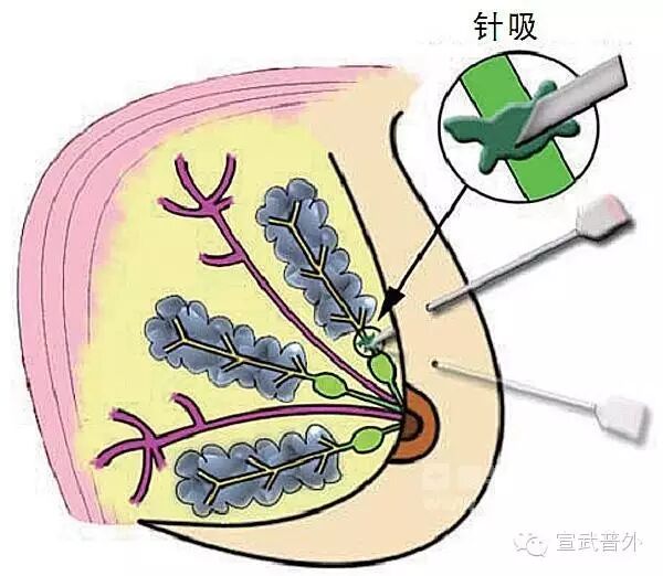 穿刺枪怎么升级乳腺穿刺术（二）_https://www.jmylbn.com_新闻资讯_第13张