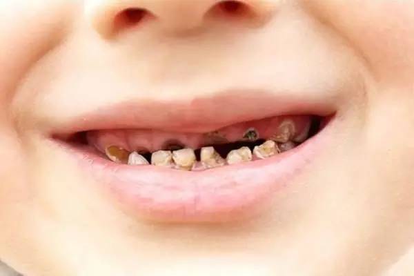 进而引牙髓炎或根尖周炎,感染到恒牙胚,导致恒牙釉质的发育不全,会