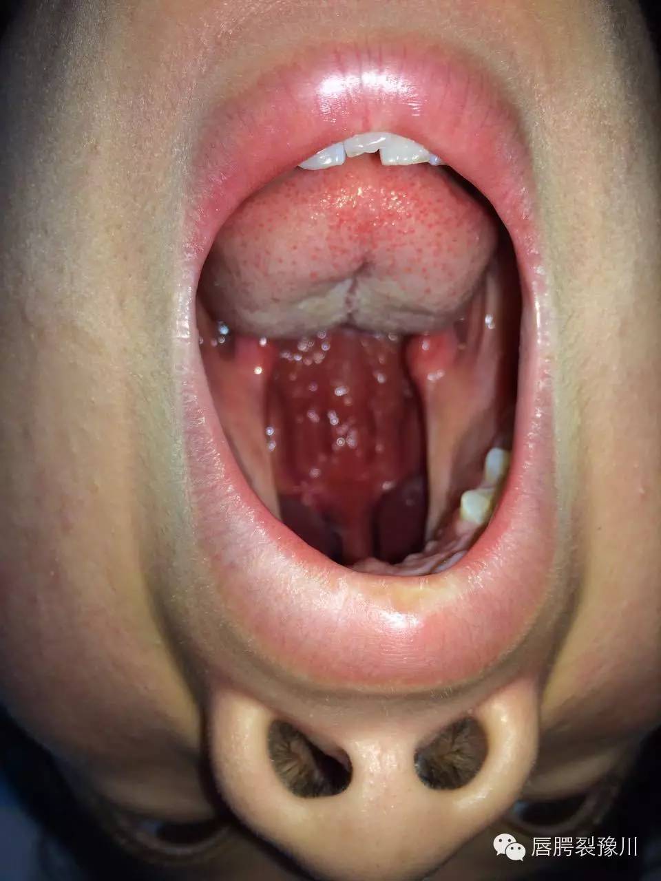 先天性口腔内腭裂图片图片