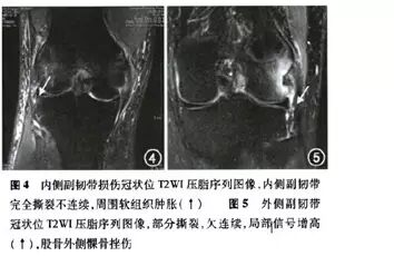 保护膝关节 关注韧带损伤 运动医学的兴起