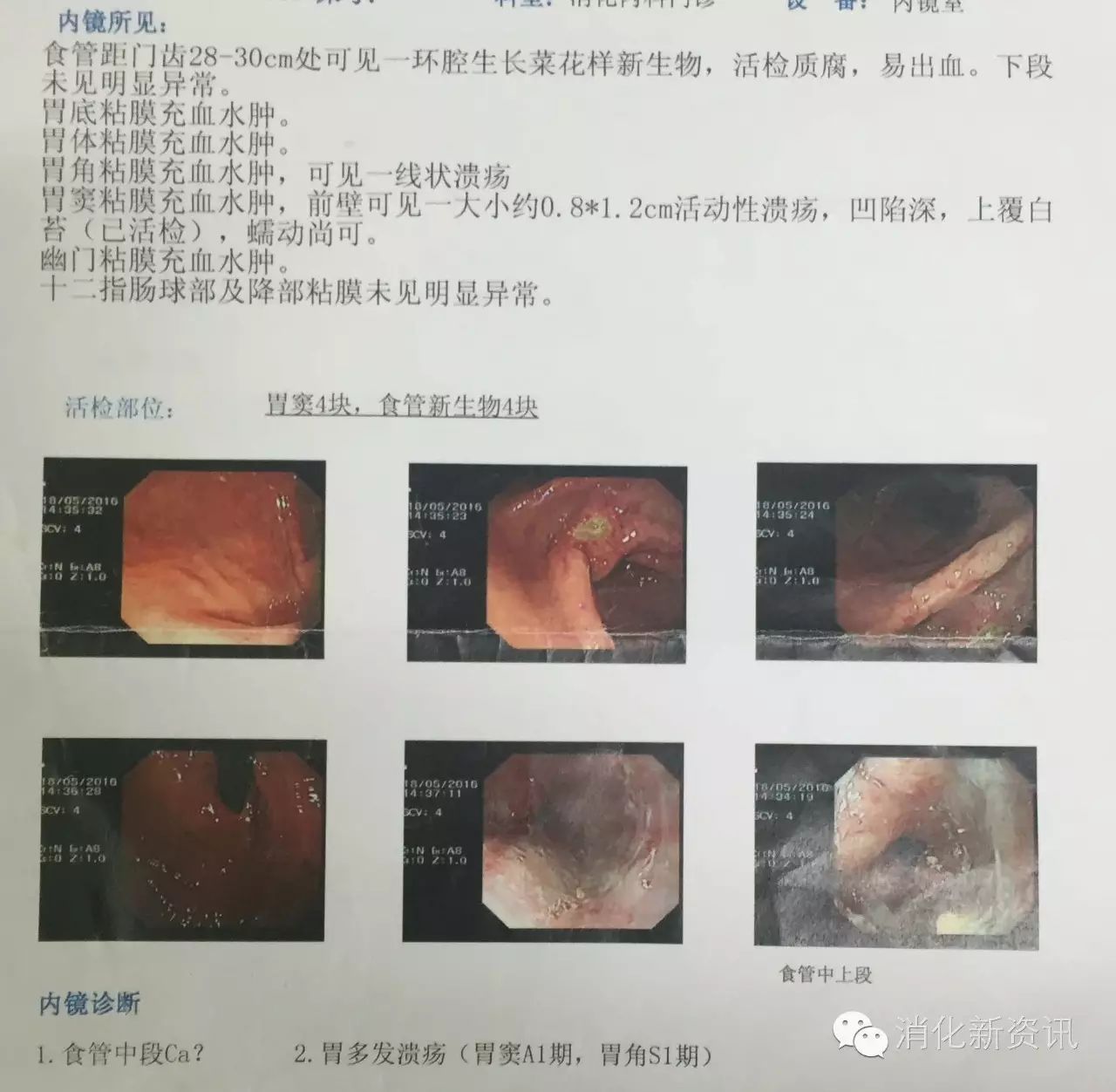 食管胃多发癌 一个比贲门胃底癌更复杂的病例 食道癌 手术 治疗方法