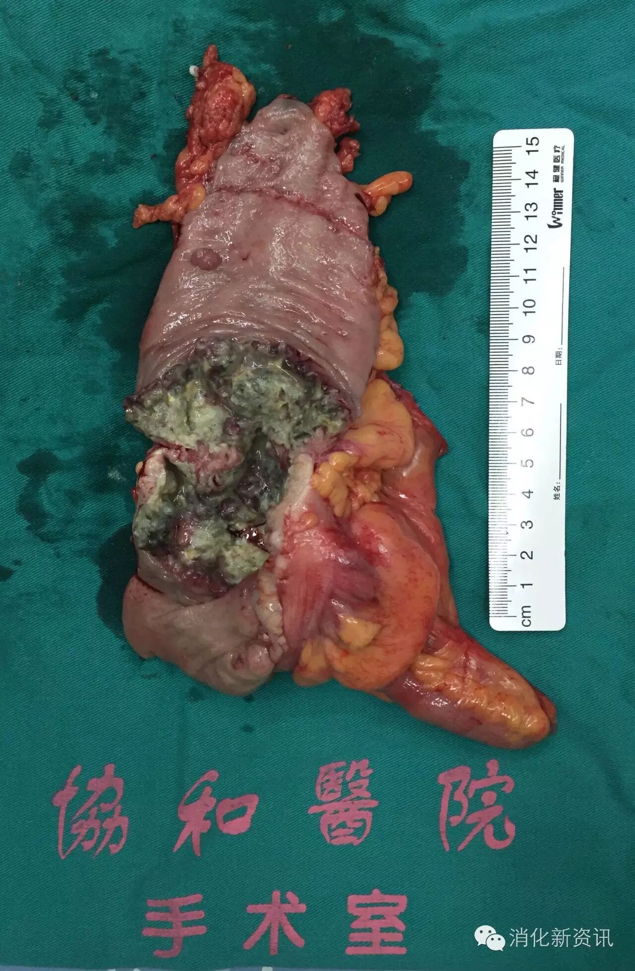 这例结肠肿瘤的深度t3,淋巴结27枚全阴性,环周切缘阴性.