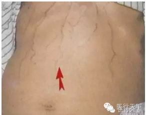 青筋凸起不可不防