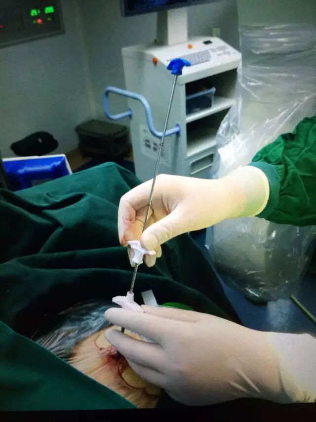 老年人椎体骨折怎么办？来广安做经皮椎体成形术