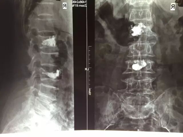 老年人椎体骨折怎么办？来广安做经皮椎体成形术