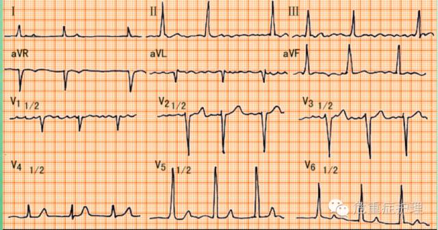 为什么选择双相波同步电复律？到底怎么回事？心电监护演示同步电复律全过程！_https://www.jmylbn.com_新闻资讯_第6张