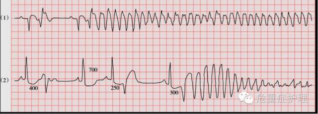 为什么选择双相波同步电复律？到底怎么回事？心电监护演示同步电复律全过程！_https://www.jmylbn.com_新闻资讯_第5张