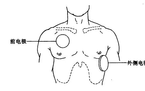 为什么选择双相波同步电复律？到底怎么回事？心电监护演示同步电复律全过程！_https://www.jmylbn.com_新闻资讯_第9张