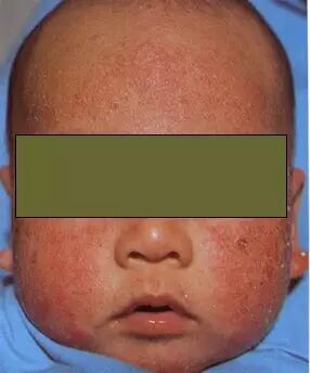 1)皮肤表现:荨麻疹,血管性水肿,湿疹等;1,ige介导类型:较为常见,即速