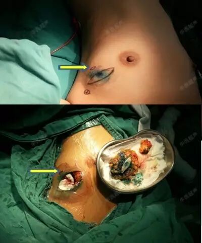 穿刺枪怎么升级乳腺穿刺术（二）_https://www.jmylbn.com_新闻资讯_第3张