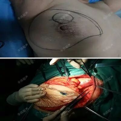 穿刺枪怎么升级乳腺穿刺术（二）_https://www.jmylbn.com_新闻资讯_第2张