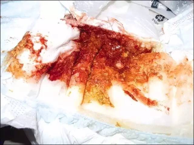 是感染或者过敏的症状之一,如果宝宝同时出现了其他症状,如大便越加稀