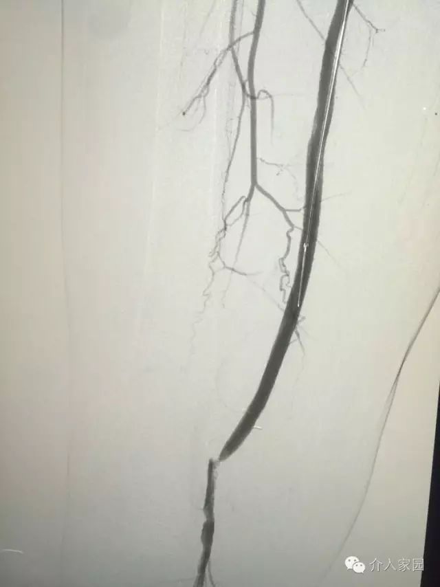 血管球囊扩张术（三）