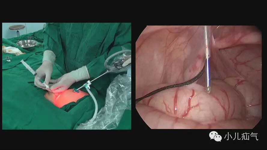 单孔腹腔镜双钩疝针注水分离左腹股沟疝内环结扎术手术演示