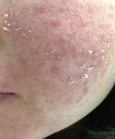 依赖性皮炎的常见表现为:激素依赖性皮炎是皮肤一些列疾病,症状的统称