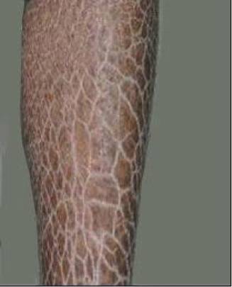 姑娘我看你手上的小水泡腿上的蛇皮纹有救哦