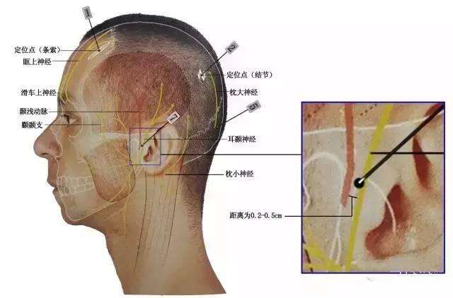 針刀治療偏頭痛效果 - 科研動態 - 龍川縣兩渡河醫院