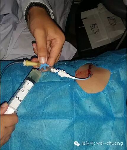 引流管怎么冲管居家护理：引流管看护和简单冲管_https://www.jmylbn.com_新闻资讯_第4张