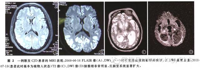 中枢神经系统感染性疾病的诊疗经验 - 神经病学俱乐部