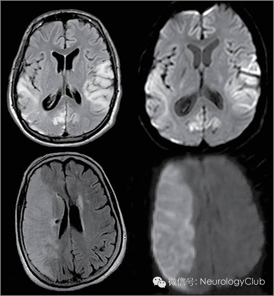 线粒体脑肌病伴高乳酸血症和卒中样发作melas患者卒中样发作的管理