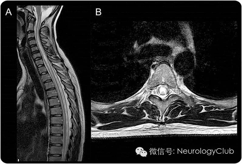 神经影像 视神经脊髓炎谱系疾病的mri特点(二)