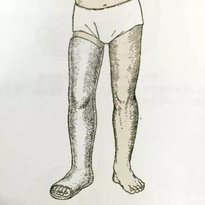 医用石膏夹板怎么软化关于骨折石膏固定技术总结及注意事项_https://www.jmylbn.com_新闻资讯_第12张