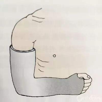 医用石膏夹板怎么软化关于骨折石膏固定技术总结及注意事项_https://www.jmylbn.com_新闻资讯_第10张