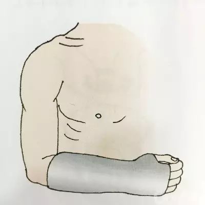医用石膏夹板怎么软化关于骨折石膏固定技术总结及注意事项_https://www.jmylbn.com_新闻资讯_第9张
