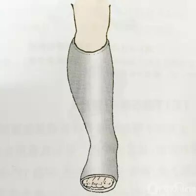 医用石膏夹板怎么软化关于骨折石膏固定技术总结及注意事项_https://www.jmylbn.com_新闻资讯_第11张