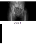 DDH的诊断、分型与治疗原则