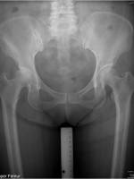 DDH的诊断、分型与治疗原则