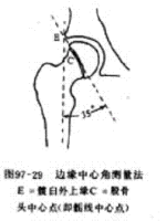 DDH的诊断、分型与治疗原则