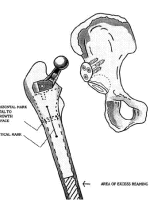 DDH的诊断、分型与治疗原则