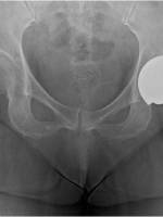 DDH的诊断、分型与治疗原则