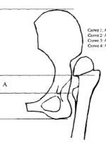 DDH的诊断、分型与治疗原则