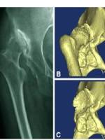 DDH的诊断、分型与治疗原则