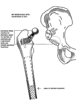 DDH的诊断、分型与治疗原则