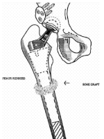 DDH的诊断、分型与治疗原则