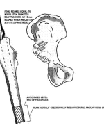 DDH的诊断、分型与治疗原则