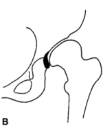 DDH的诊断、分型与治疗原则
