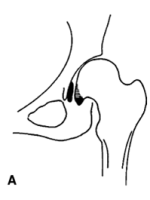 DDH的诊断、分型与治疗原则
