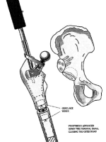 DDH的诊断、分型与治疗原则