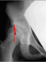 DDH的诊断、分型与治疗原则