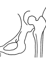 DDH的诊断、分型与治疗原则