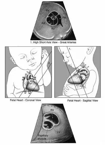 aha发布第一部胎儿心脏病诊断和治疗指南