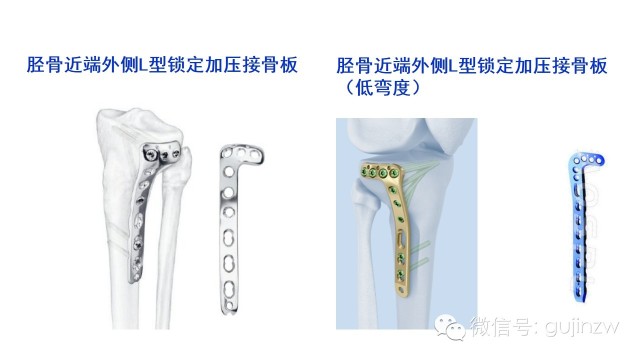 临床常见创伤锁定板及其对应部位 - 小骨头 - 小骨头的博客