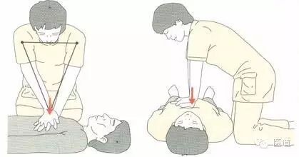 心电监护怎么看图【PLUS版】心电图危急值识别及紧急处理，值得每个医生收藏！！！_https://www.jmylbn.com_新闻资讯_第32张