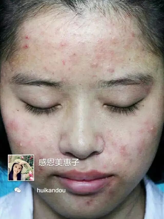一个痘痘200条虫,长痘痘的那脸原来那么脏!你有痘,你先看
