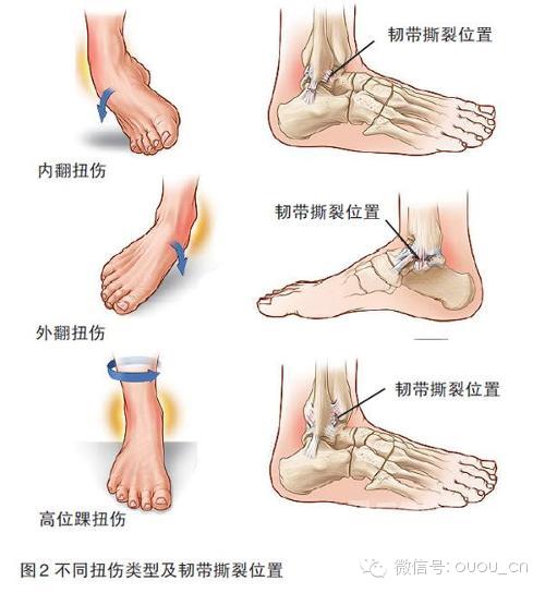 脚踝扭伤处理及恢复方法